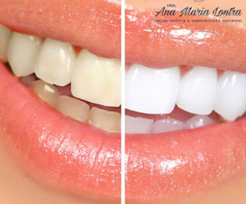Sorriso após clareamento dental realizado no consultório da Dra. Ana Maria Lontra